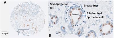 The Divergent Function of Androgen Receptor in Breast Cancer; Analysis of Steroid Mediators and Tumor Intracrinology